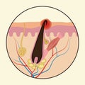 Ingrown hairs. Medical scheme of hair regrowth.